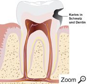 Karies in Schmelz und Dentin